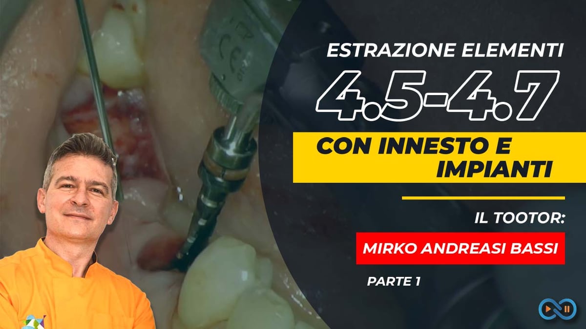 Guided_Bone_Regeneration_video_Bassi