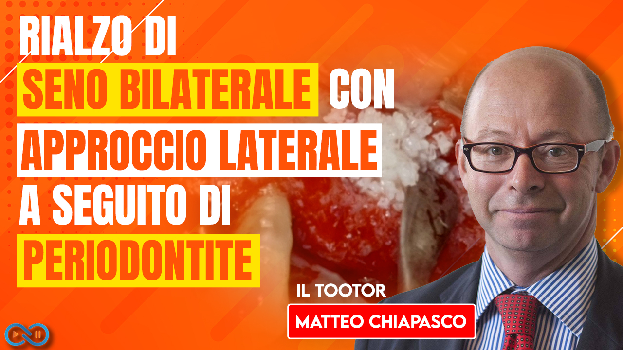rialzo_seno_bilaterale_approcio_laterale_periodontita