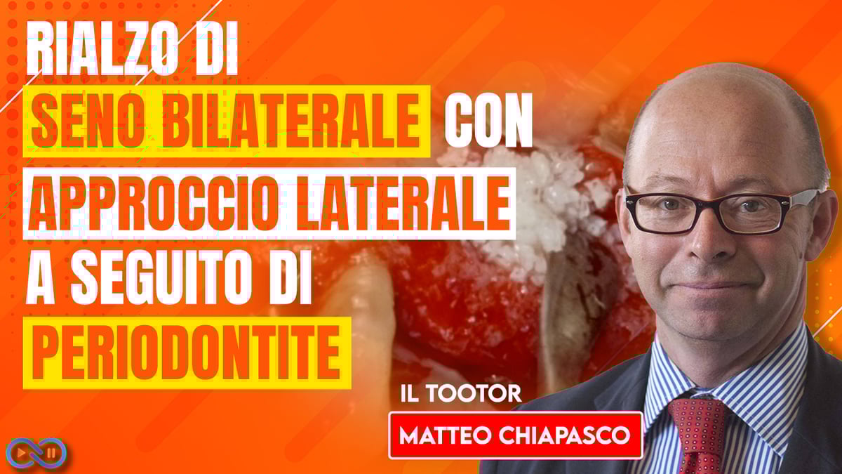 rialzo_seno_bilaterale_approcio_laterale_periodontita