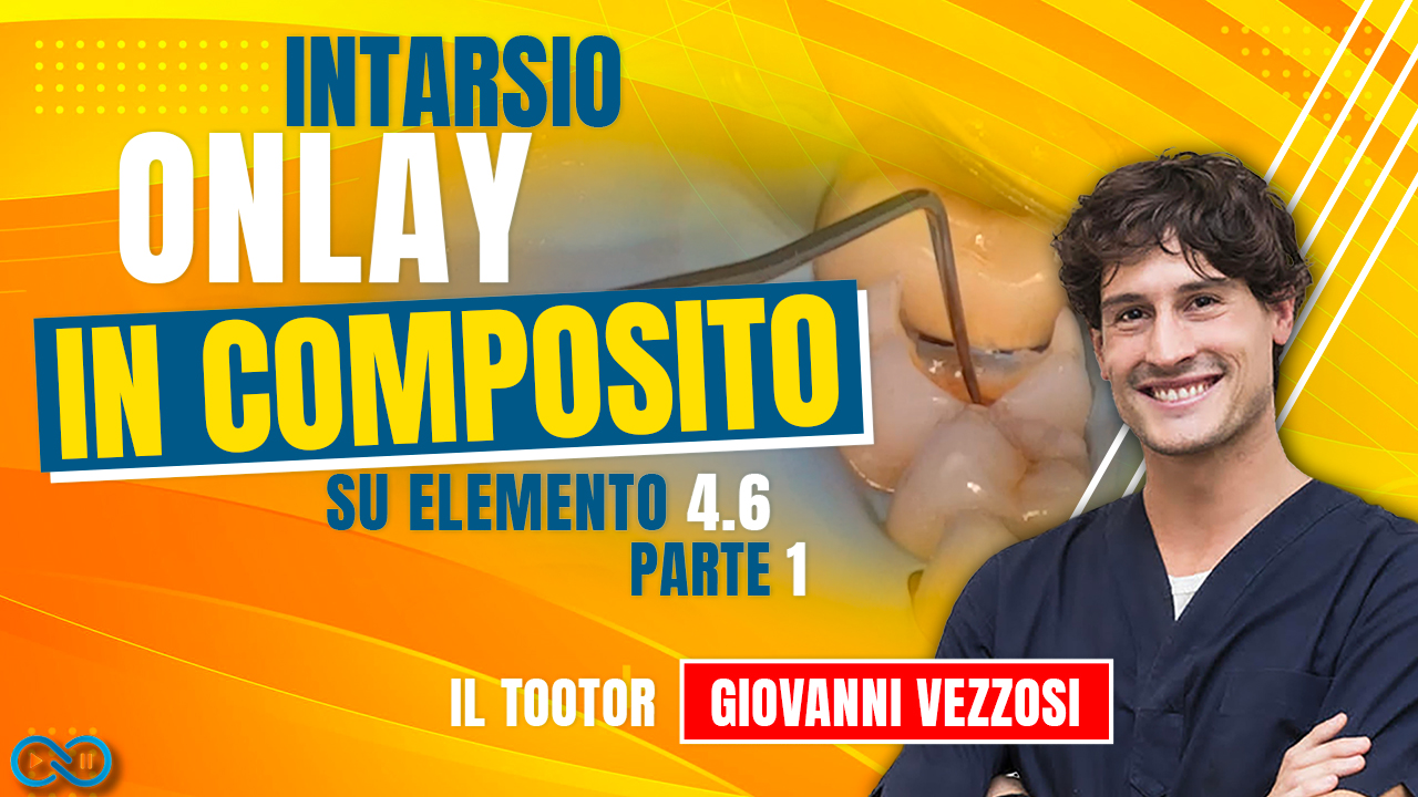 intarsio_onlay_composito